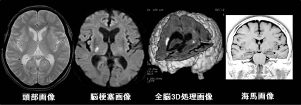 頭部の画像、脳梗塞の画像、全脳の3D処理画像、海馬の画像