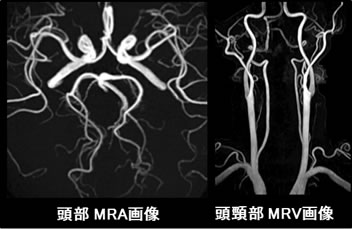 造影剤を使わずに撮影した脳と首の血管の画像