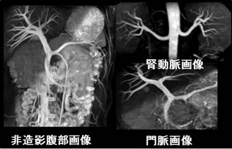 造影剤を使わずに撮影した腹部の血管の画像