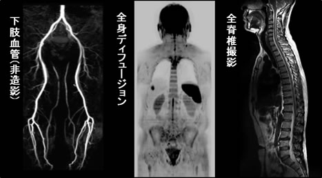 脚の血管(造影剤なし)、全身ディフュージョン、全脊椎の画像