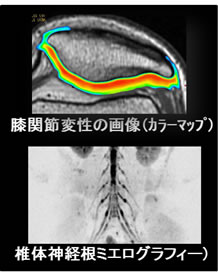 膝関節のカラーマッピング画像と神経根の画像